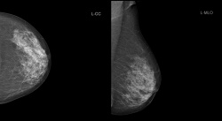 Рентгеновская цифровая маммография 
